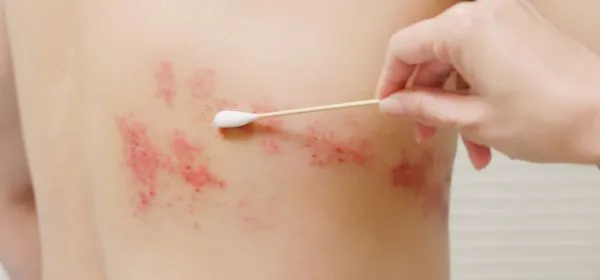 Um a cada três adultos é afetado pela herpes-zóster, que pode causar dores extremas